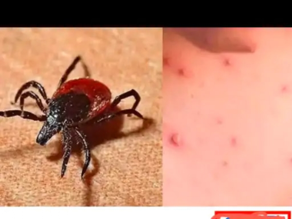 स्क्रब टायफस: पवार यांच्या भाचीवरही उपचार सुरु कुटुंबियांतील दोघींची प्रकृती स्थिर, गावात भीतीचे वातावरण