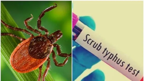जिल्ह्यात स्क्रब टायफसबाबत खबरदारी बाळगण्याचे आरोग्य विभागाचे आवाहन जिल्ह्यात स्क्रब टायफसबाबत खबरदारी बाळगण्याचे आरोग्य विभागाचे आवाहन
