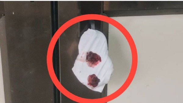 जिल्हा स्त्री रुग्णालयातील हॉस्पिटलमधील जळीत कक्षाला अधिकाऱ्यांच्या उपस्थितीत सील कक्ष बंद